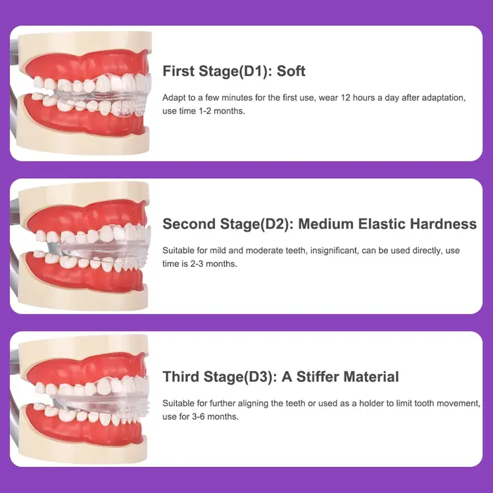 Appareil dentaire, accolades orthodontiques, entraîneur de dents, entraîneur d'alignement, embout po